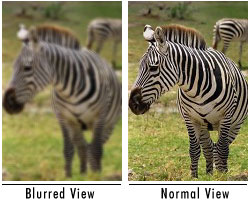 Amblyopia (Lazy Eye)